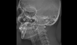 Lateral oblíqua da mandíbula